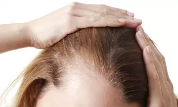 Unveiling myths about female pattern baldness