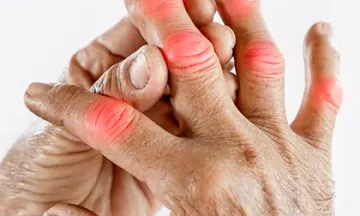 Use homeopathy to ease gout pains