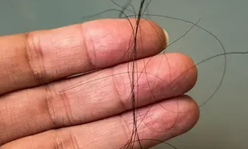 What are the reasons for hair fall?
