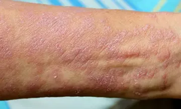 What is lichen planus classification?