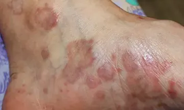 What is the onset of lichen planus?