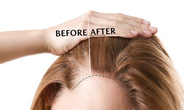 Non-surgical hair replacement vs. Hair laser treatment