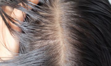 Can bioengineered hair treatment reduce hair fall?