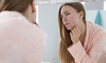 10 facts about acne