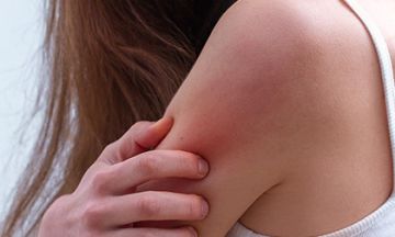 5 things to know before skin allergy treatment
