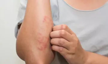 How to get rid of eczema?