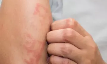 How to get rid of eczema?