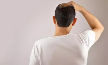 Is there any effective treatment for male pattern baldness?