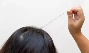 Trichotillomania: Symptoms & Treatments