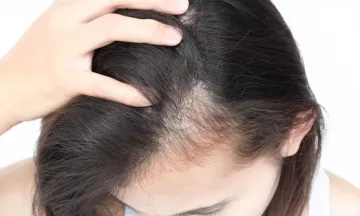 MDCUs Research on LowLevel Laser Therapy to End Hereditary Hair Loss with  Promised Results in Six Months  Chulalongkorn University