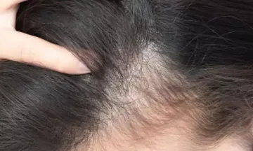 Is Female Baldness Hereditary?