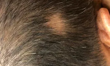 Is alopecia areata permanent?