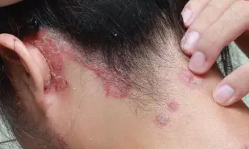 Scalp Psoriasis driving you mad? Try homeopathy