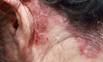 What does psoriasis look like on the scalp?