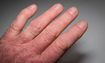 Natural Remedies for Lichen Planus
