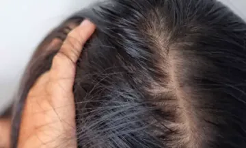 Winter hair problems and tips to avoid them