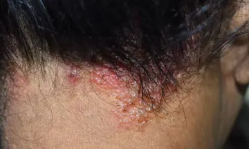 Treatment options for Seborrhoeic Dermatitis