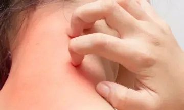 Types of Allergies & Homeopathy Treatment