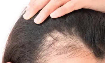 Thinning hair could indicate female pattern baldness