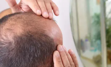Male pattern hair loss – Symptoms and complications