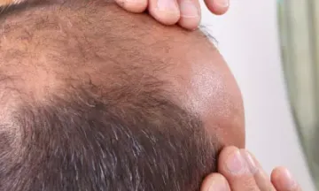 Reasons for hair loss in men