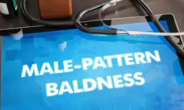 Ways to manage Male Pattern Baldness