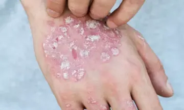 Psoriasis Triggers and Treatments