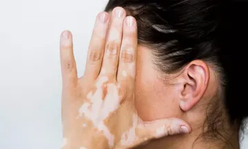 What increases your risk for developing vitiligo?
