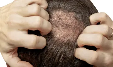 10 Most effective hair loss treatments