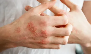 All you need to know about allergic eczema