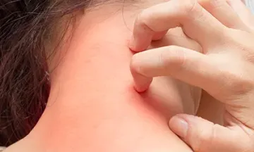 Are skin allergies hereditary?