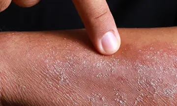 Atopic eczema & allergic rhinitis