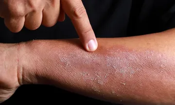 Atopic eczema & allergic rhinitis