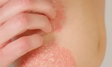 How to care for psoriasis symptoms when the season changes?