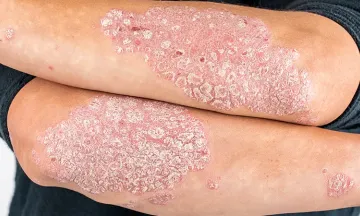 Is psoriasis hereditary?