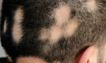 Why does alopecia areata occur?
