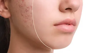 10 things you can do to treat acne