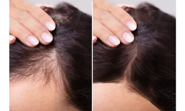 Hair vitalizing treatment vs. GroHair Treatment