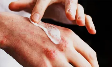 Is DermaHeal good for eczema?
