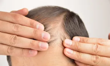 10 Common Reasons for Hair Loss in Men