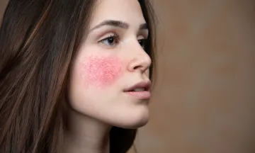 10 common things that trigger Acne Rosacea