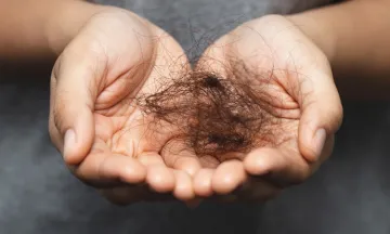 10 Reasons for Hairloss in Females