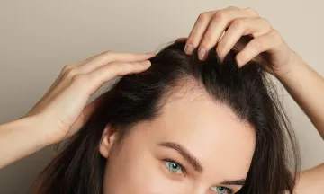 5 things you should know about Female Pattern Hair Loss