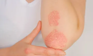 8 Things You Need to Know About Psoriasis
