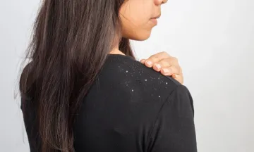 Don’t Ditch Black….Ditch the Dandruff