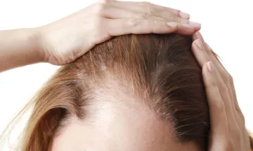 Homeopathy is the best treatment for female pattern baldness. Know Why