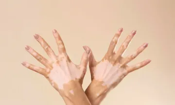 Most common vitiligo facts you should know