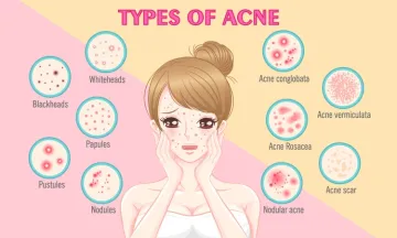 Thought acne was just a red spot? Know the different types of acne