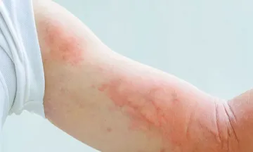 Urticaria and Its Homeopathy Treatment