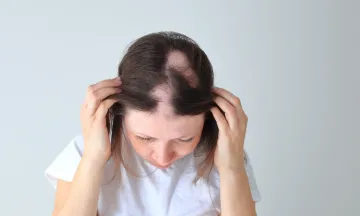 Destroyed in Patches: Alopecia Areata can make you lose a lot more than just hair in patches